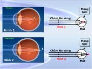 Bài 48.5, 48.6, 48.7, 48.8 trang 98, 99 SBT Vật Lý 9: Trong trường hợp nào dưới đây, mắt phải điều tiết mạnh nhất?